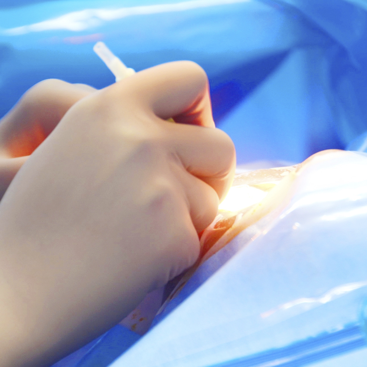 Sub-Retinal Transplantation