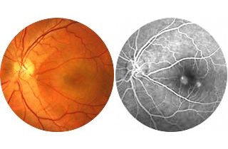  Fluorescein Angiography (FA)