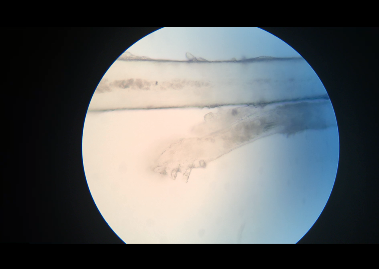 An eyelash mite on a blepharitis patient 