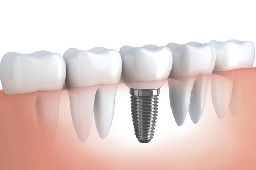 Dental Implant Teeth Replacement