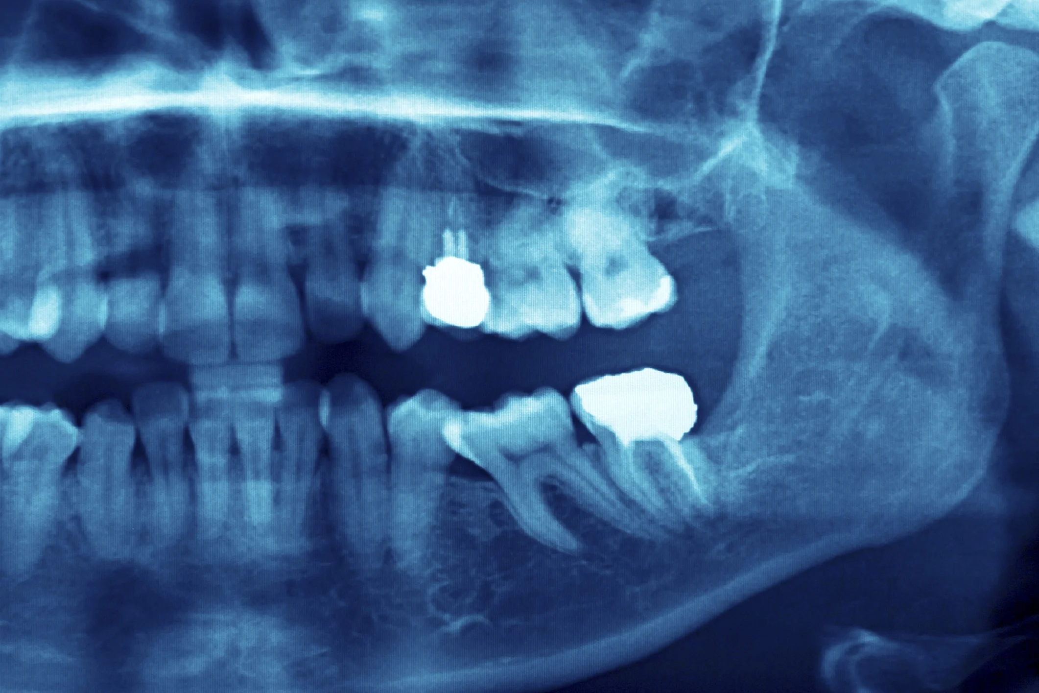 Dangers of a Damaged Tooth