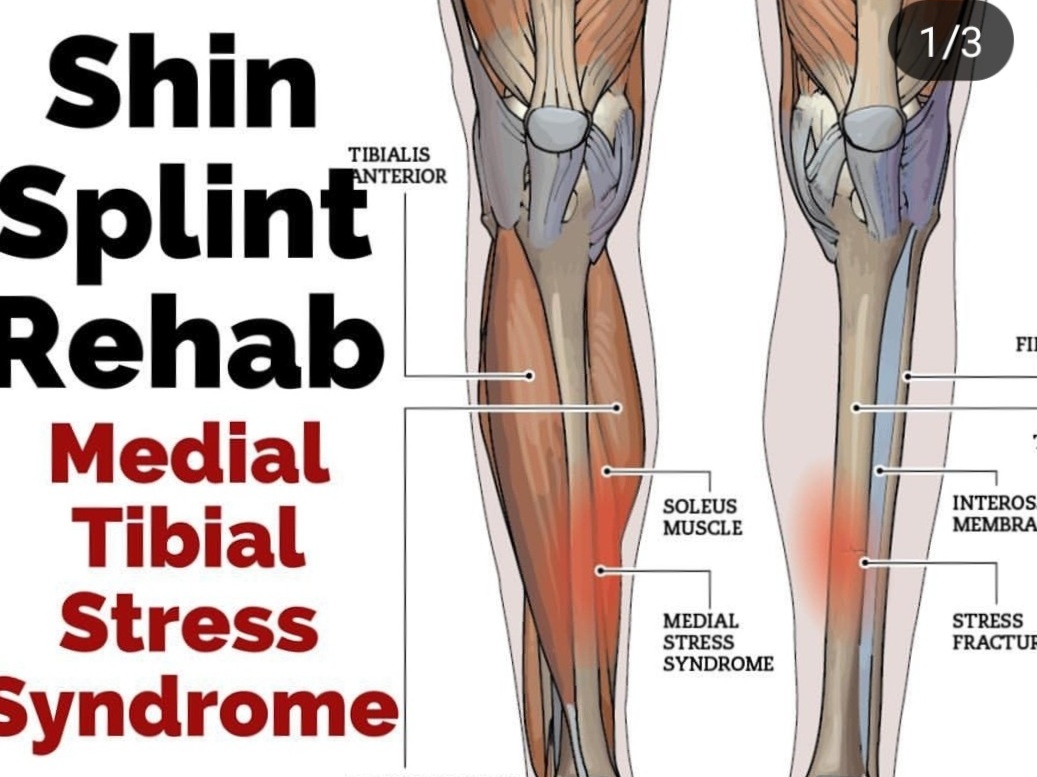 Move Forward From Your Shin Splints The Spot Athletics