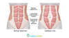 Locus Disect Ultimate Guide to Diastasis Recti — Life Well Lived