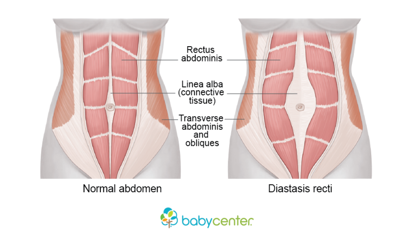 Diastasis Recti diagram courtesy of Baby Center.