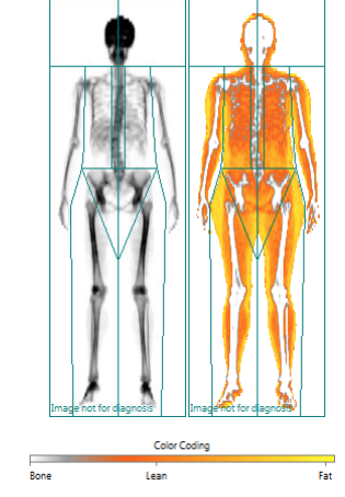Dexa bone density.png