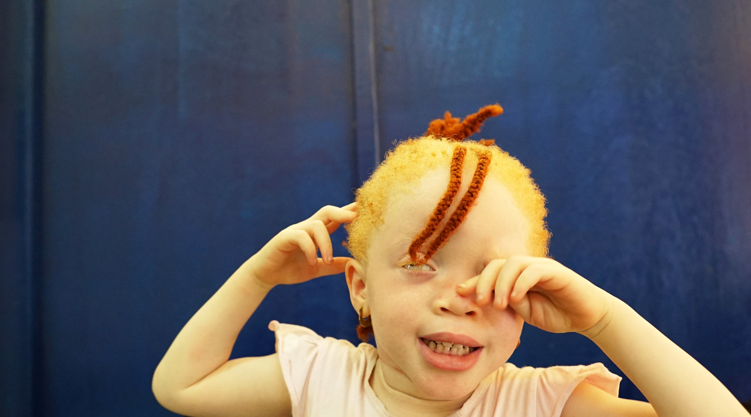 Albinism-CAMDSC03975.jpg