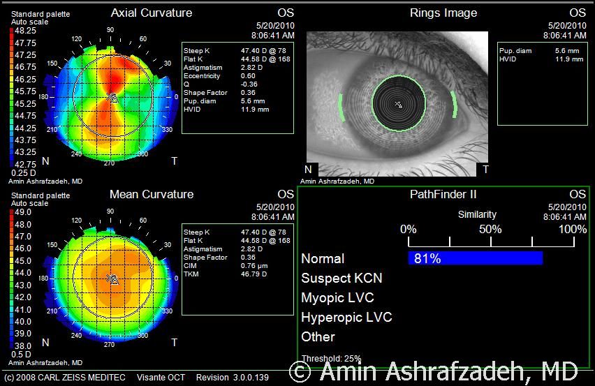 Technology — Advanced Clinical Eyecare