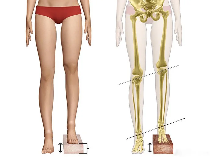 Structural Legs Leg Length Difference: Causes & Treatments | GC Foot Centres
