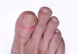 Ingrown toenail1.jpg