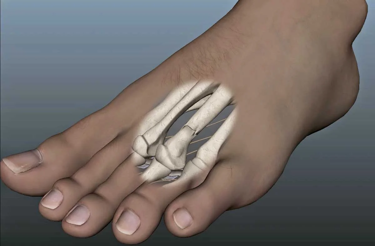 Metatarsal Stress Fractures
