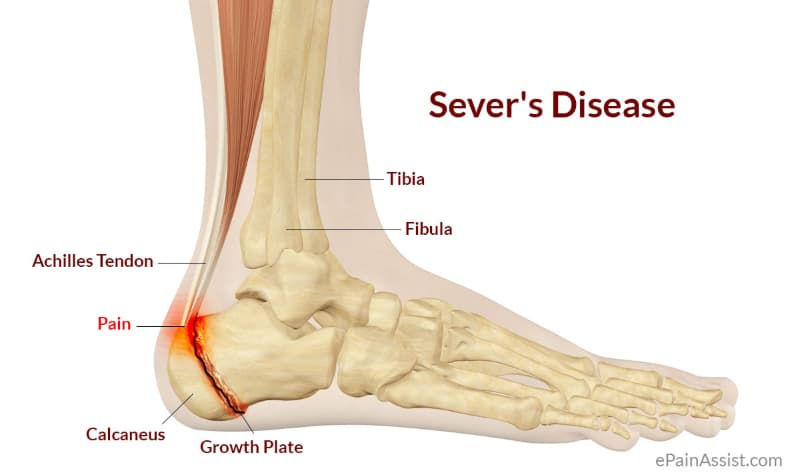 Traction Apophysitis Growing Pains Achilles Tendon Calcaneal