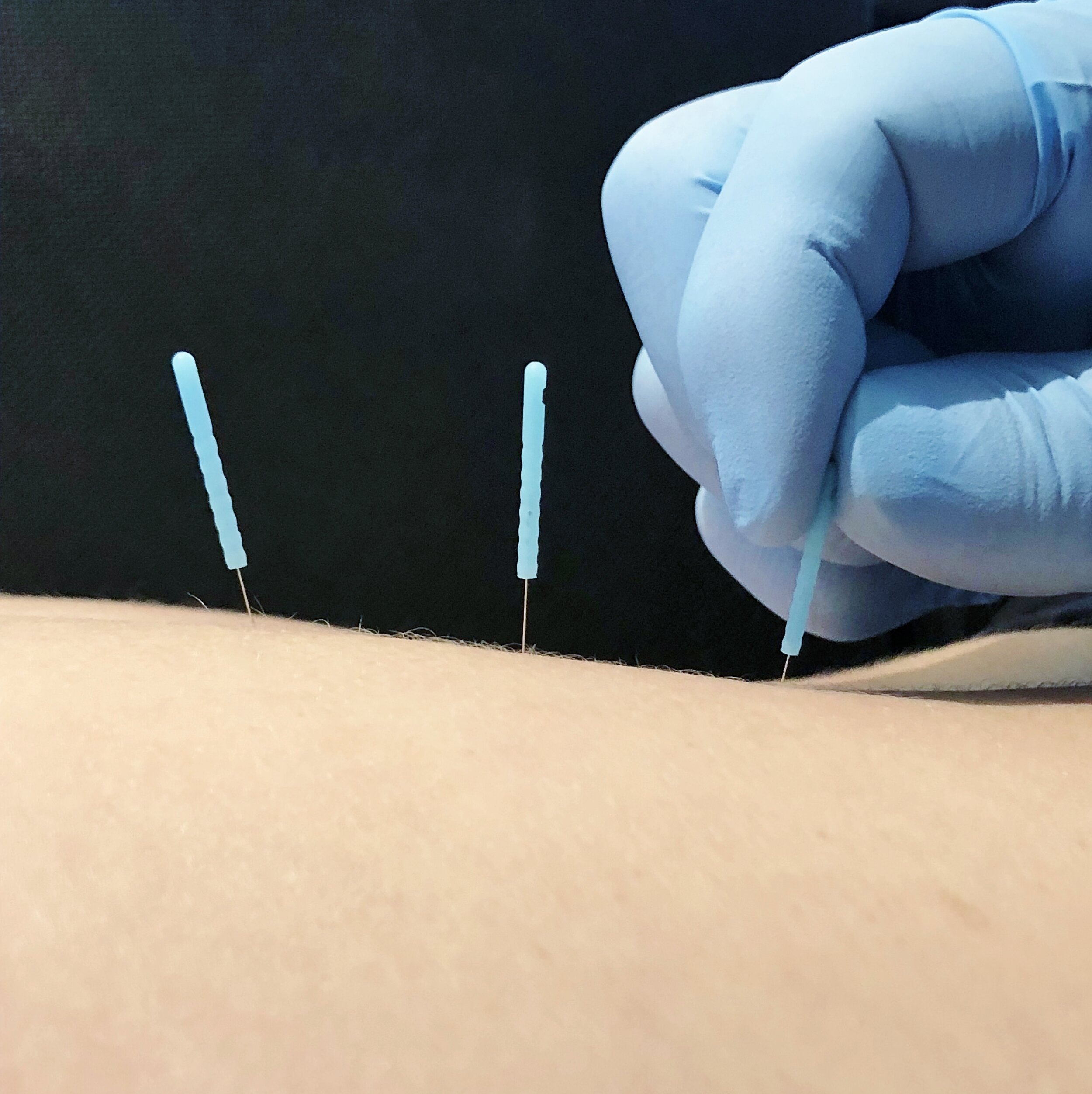 An Overview Of Dry Needling — Complete Game Physical Therapy