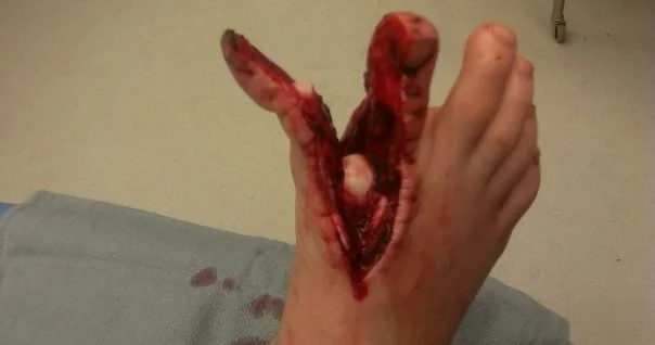 Wounds.Foot_.Axe_.jpg