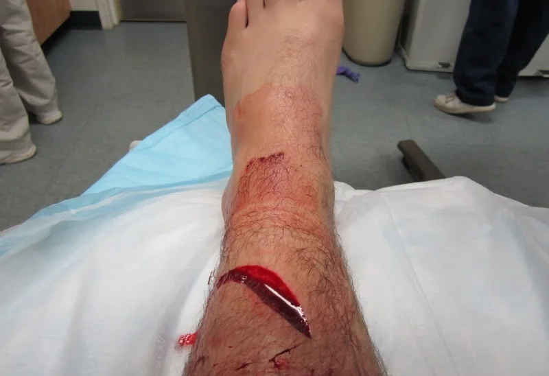 Wound.Axe_.Leg_1.jpeg