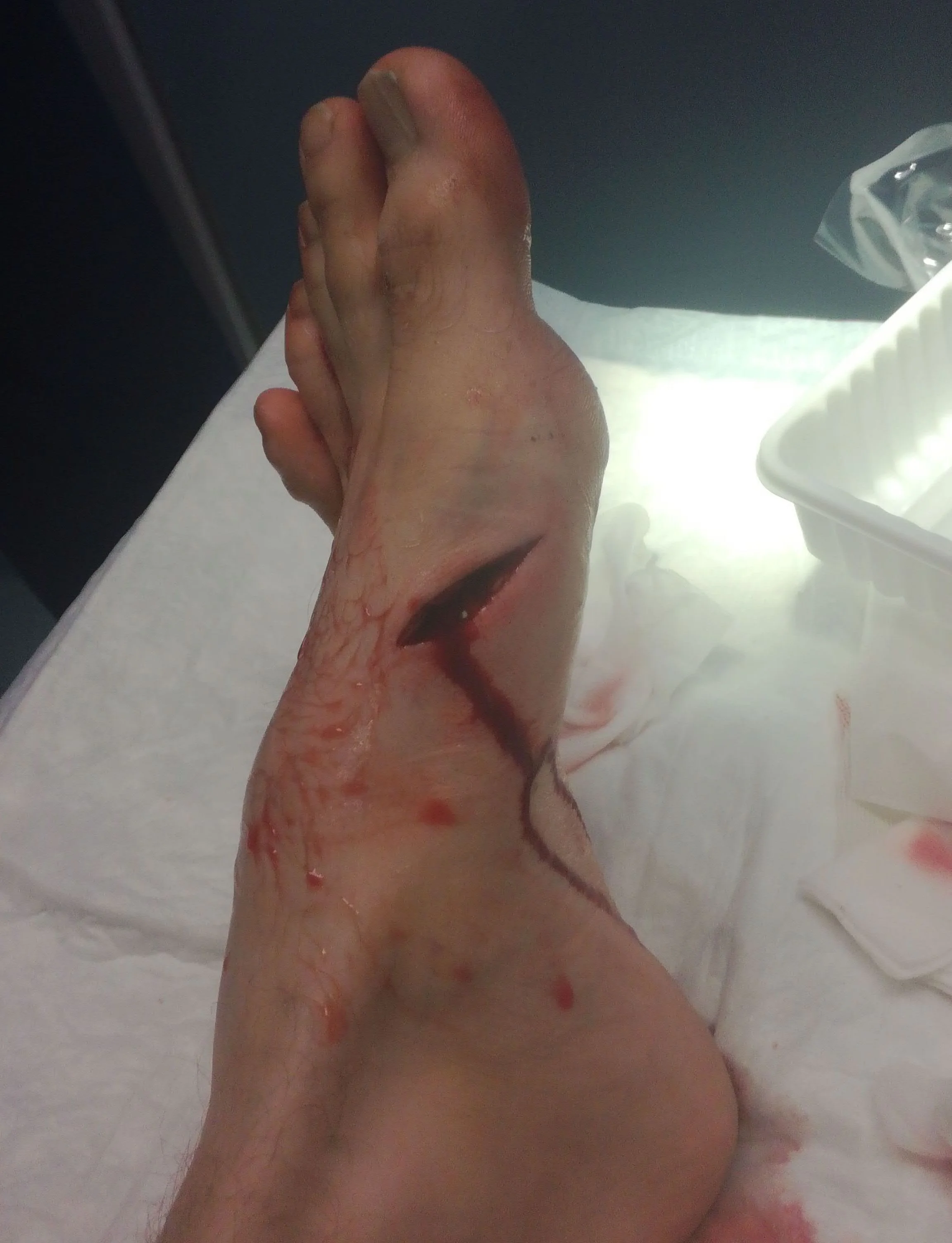 Blades are neutral. They bear no malice. That is good because it makes for a predictable universe. An attitude of personal responsibility is a good place to start when it comes to safety. Fortunately no tendons cut and no permanent damage here.