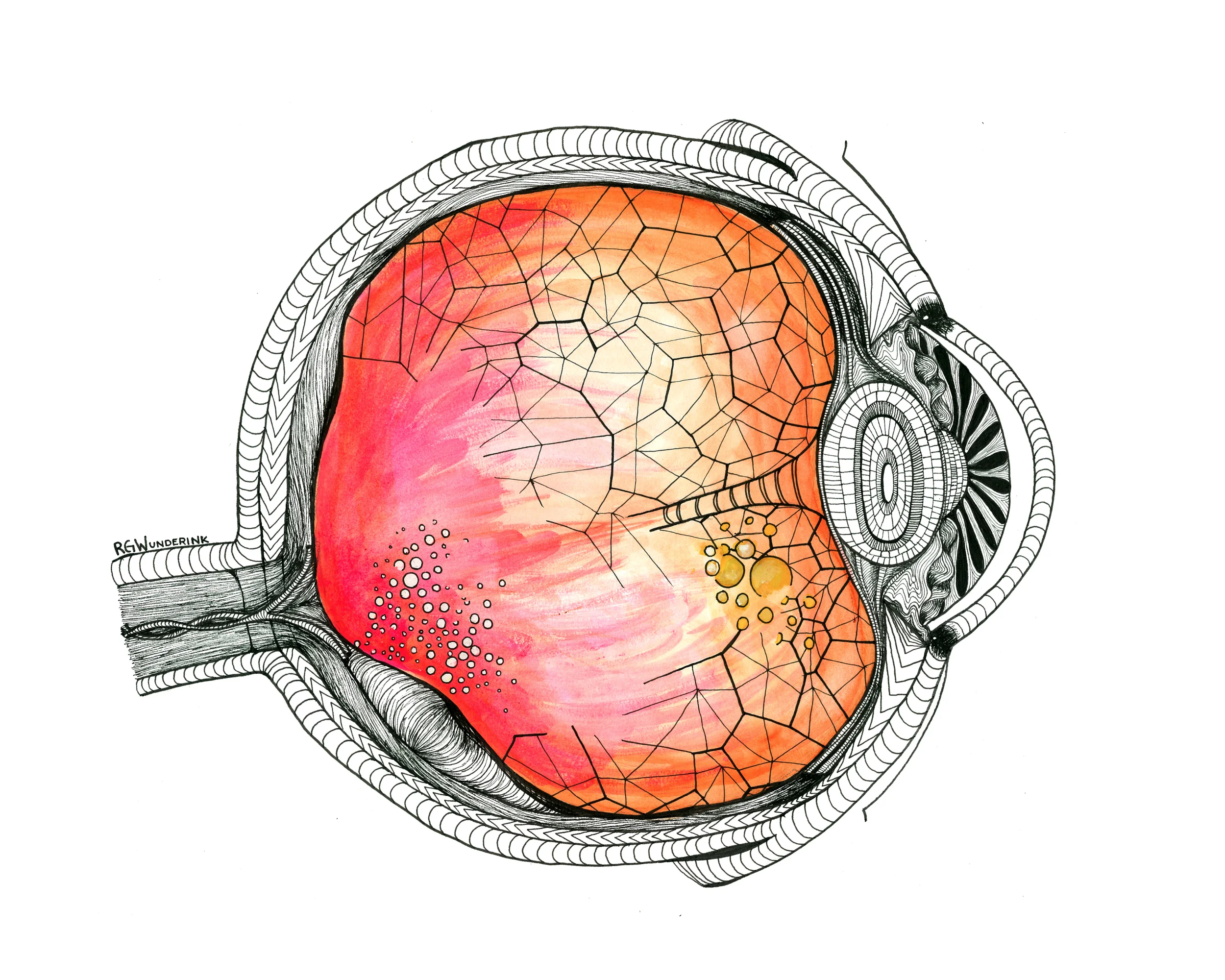 "dissonant anatomy: vitreous detached eye"