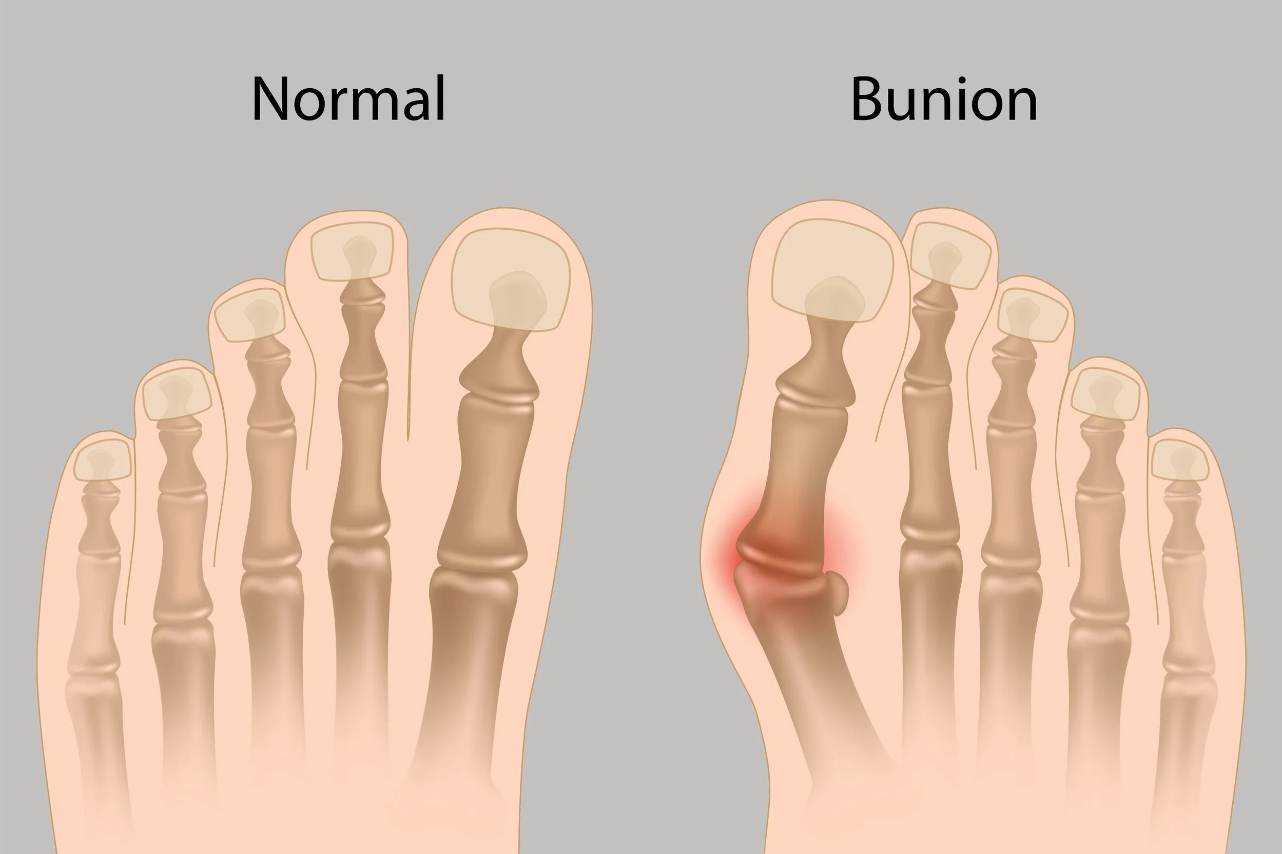 Newton Podiatrist treats bunions & hammertoes