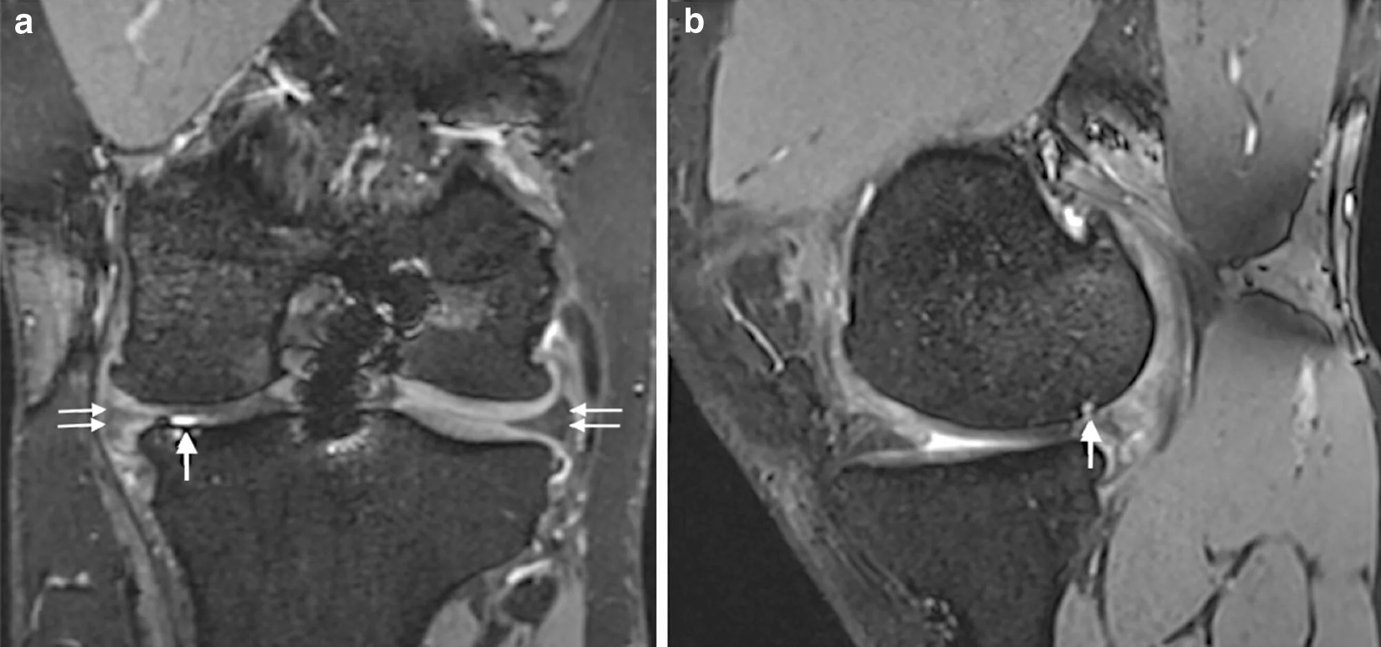 Coronal (a) and sagittal (b) reconstructions of 3D T2 True-FISP sequence. Left knee of a 30-year-old player 9years after ACLrevision surgery with combined partial medial meniscectomy. a Bilateral meniscal extrusion of ≥ 2mm (double arrows) resulting in a meniscus score of 4 on both sides. a, b Chondral grade 4 lesion to the medial femur condyle and tibial plateau (thick arrows), resulting in a medial tibiofemoral cartilage score of 32. b Probable chronic postero-medial subluxation of the medial femur condyle.