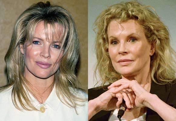 kim-basinger-worst-celebrity-plastic-surgery.jpg