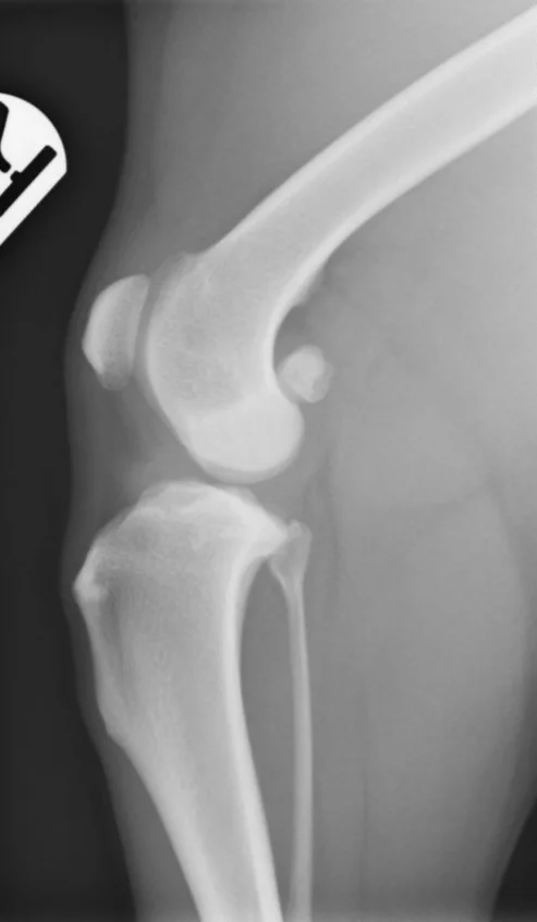 preop-xray-right.jpg
