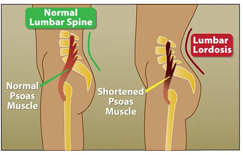Tight-Psoas-back-pain.jpg