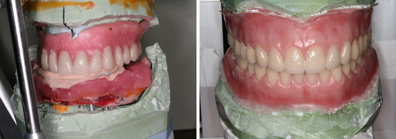 Full Denture Case: The workup to the patient's new set of dentures.