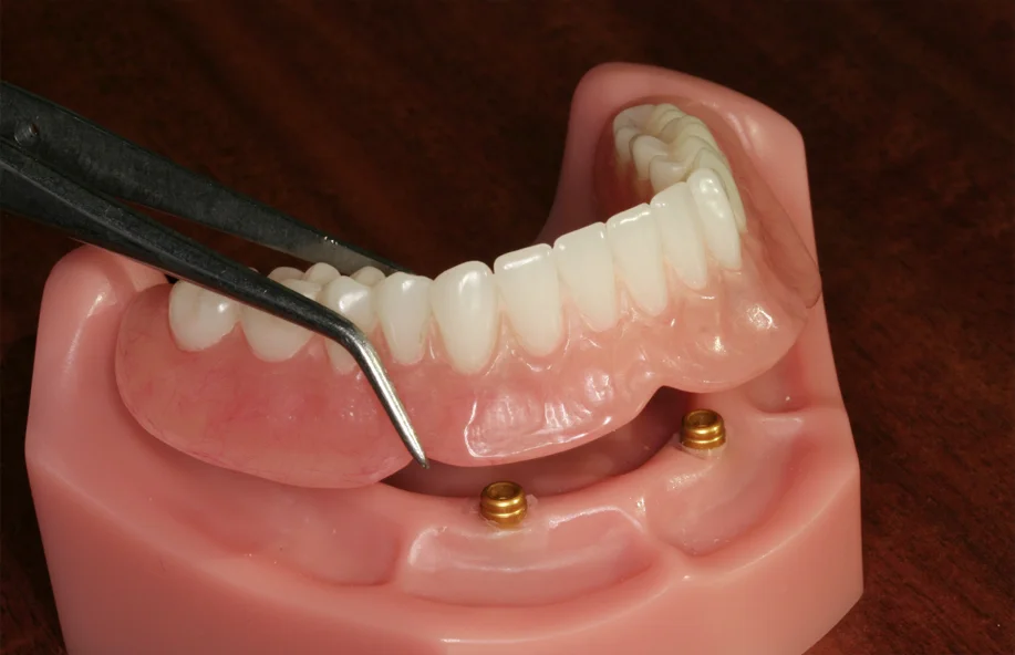 Model of a complete denture supported by implants