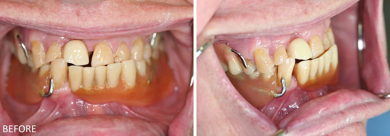 Partial Dentures Case: Before treatment