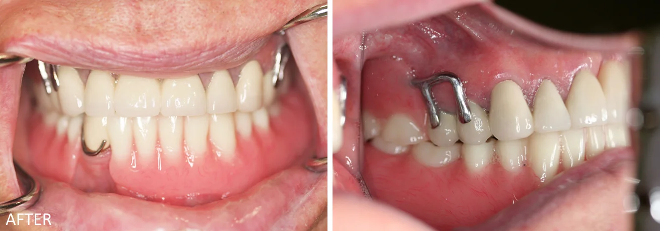 Partial Dentures Case: After treatment