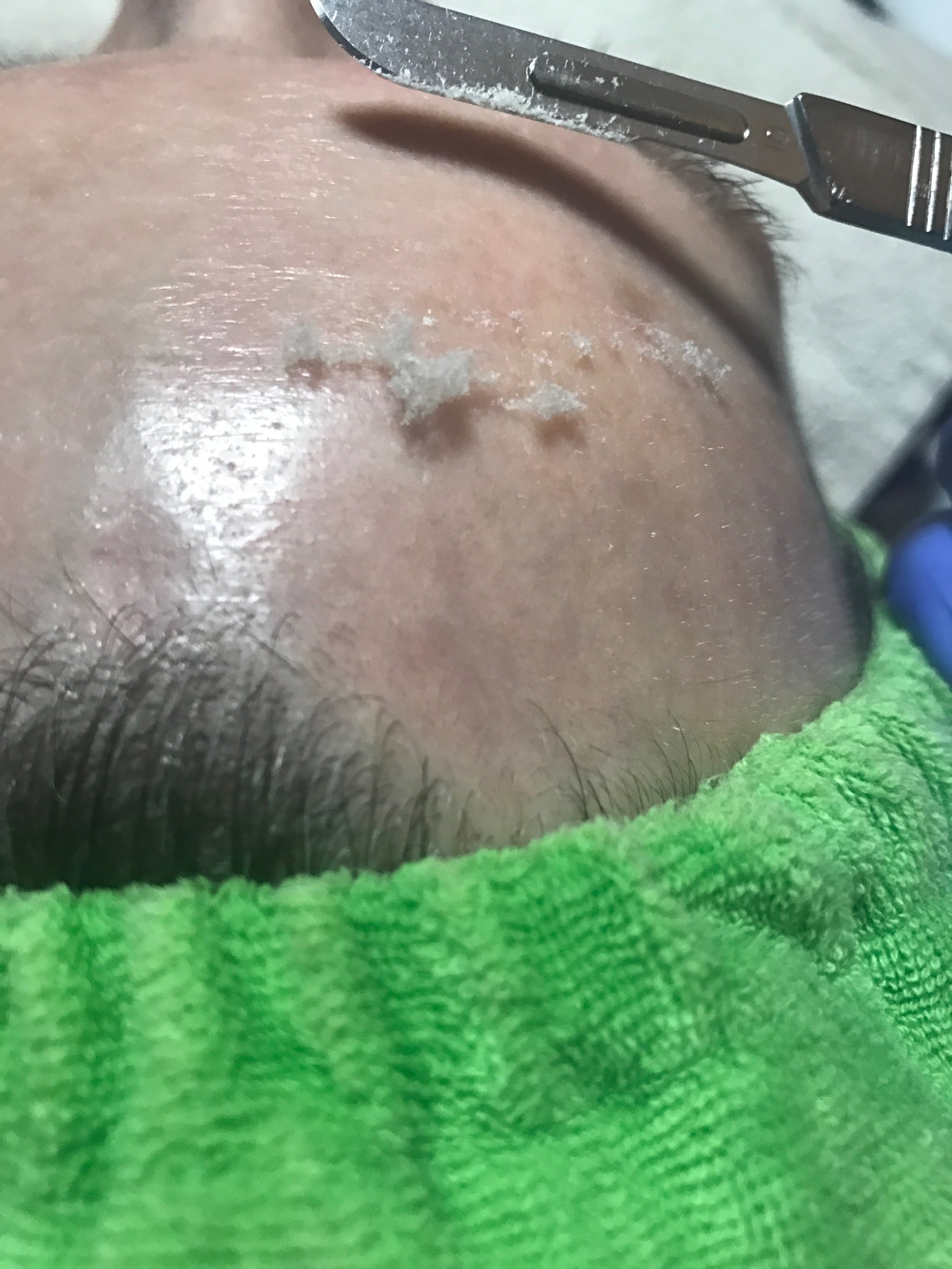 If you're like, "wtf is this?!" and perhaps slightly frightened of that blade - DON'T BE! Focus rather on all that dead skin! Dermaplaning does not hurt, but it does give you a fantastic exfoliation!