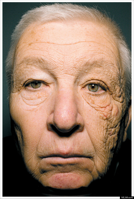 This photo demonstrates intrinsic vs extrinsic aging.  In 2012 the New England Journal of Medicine published this photo. This 65 year old man had been a delivery truck driver for 28 years. You can see the advanced aging on the left side of his face from UV exposure versus the right side of his face, which was better protected.&nbsp;