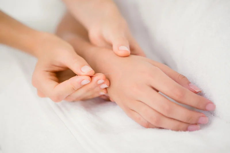 A person receiving an acupuncture treatment, with a practitioner inserting a thin needle into their forearm.