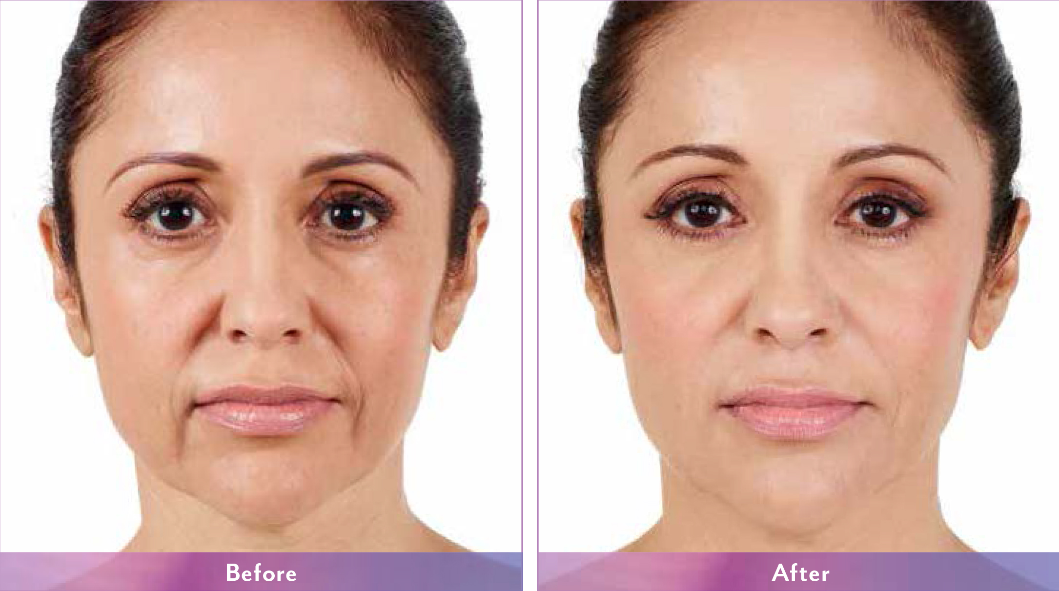 Juvederm-1.jpg