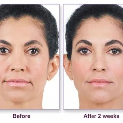 Juvederm-1-2-250x250.jpg
