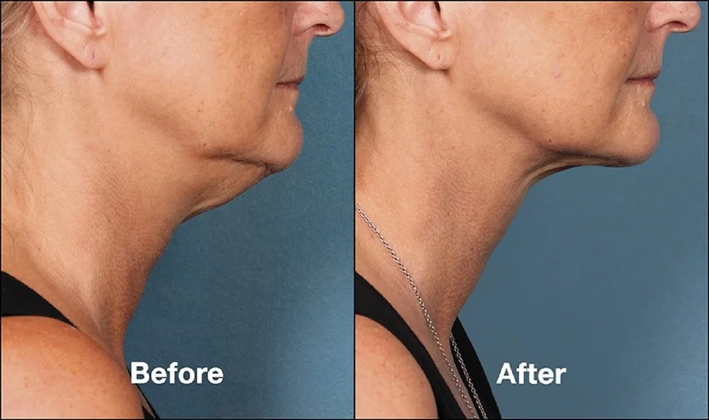 kybella 2.jpg