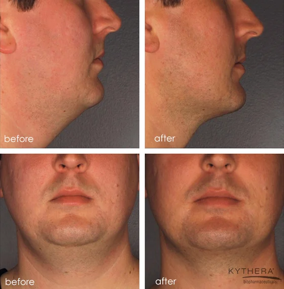 kybella 1.jpg