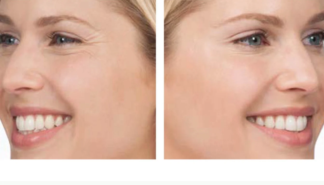 beofre+and+after+crows+feet.jpg