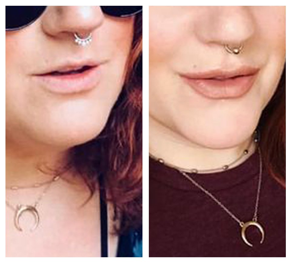 Lip Filler B&A 4.jpg