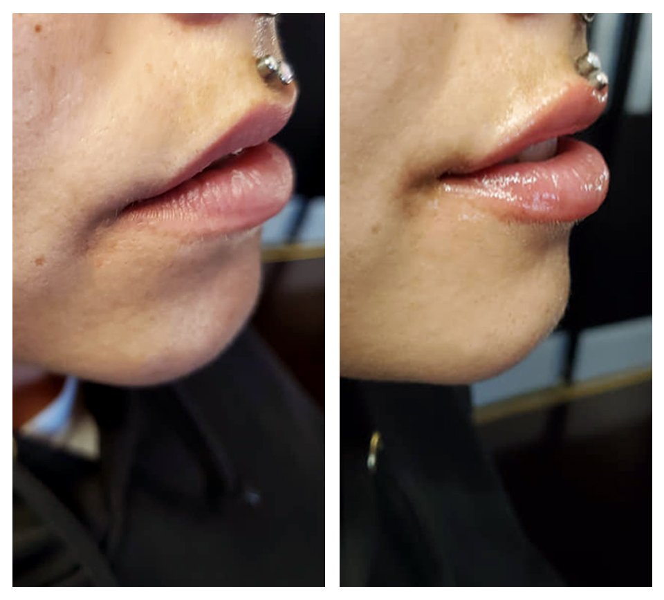 Lip Filler B&A 5.jpg