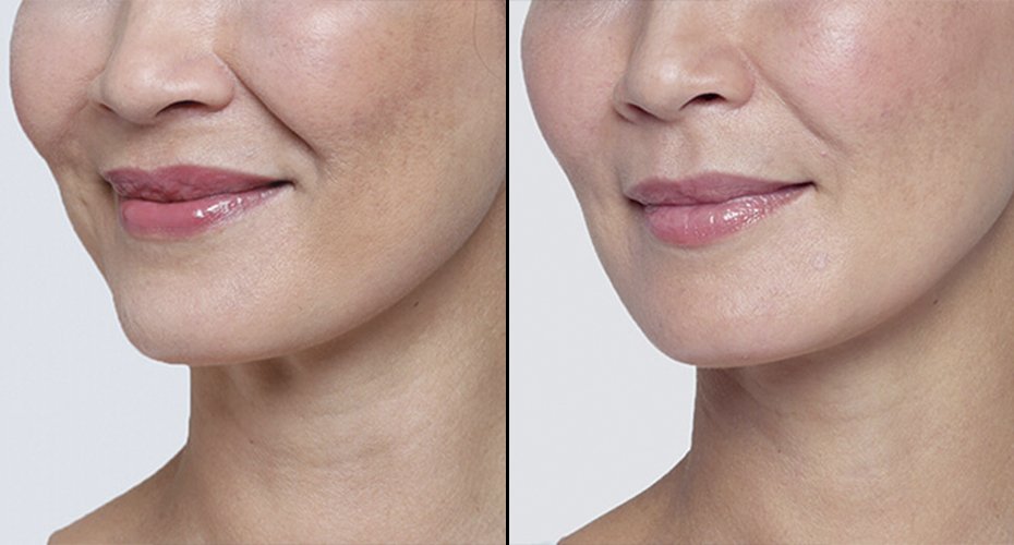 Lip Filler from 99€*  Lip Injections in top quality at M1 Med Beauty