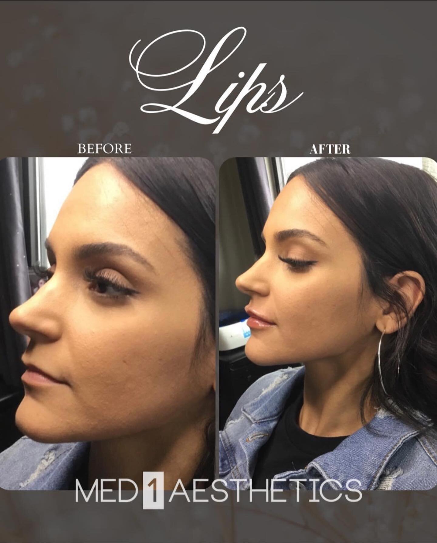 𝐵𝑒𝓈𝓅𝑜𝓀𝑒 𝐿𝒾𝓅𝓈

Lips should never be viewed as &ldquo;one size fits all&rdquo;. 
RN, Nurse Injector, Peggy burns will work to understand your desired outcome, and create a perfectly balanced lip shape that&rsquo;s tailored to your needs. 

T