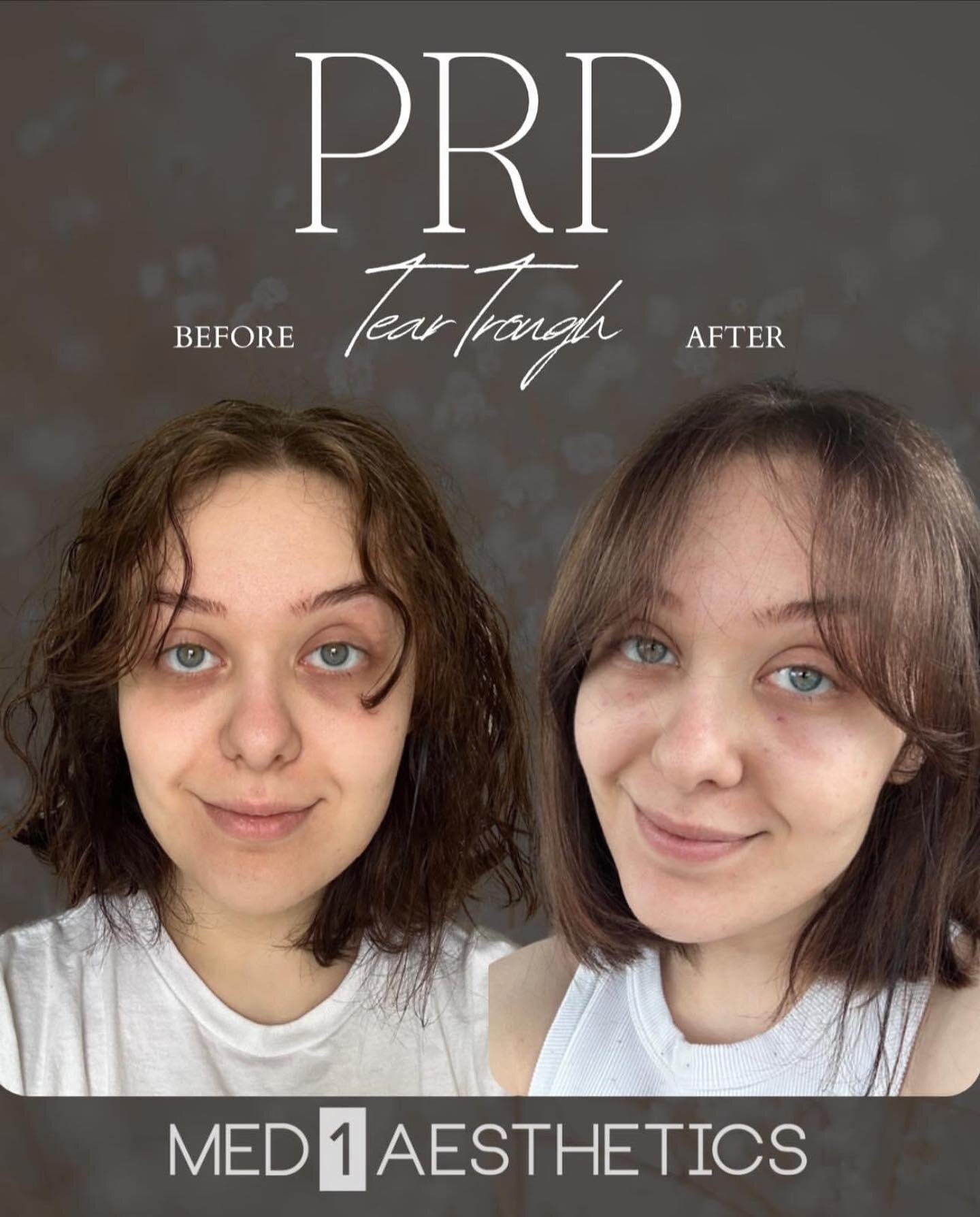 Let&rsquo;s talk about PRP! 

Platelet-rich plasma (PRP) therapy uses injections of a patient&rsquo;s own platelets to accelerate healing. Aesthetically, PRP haas many uses from reducing wrinkles, plumping the skin, reducing deep creases, improving t