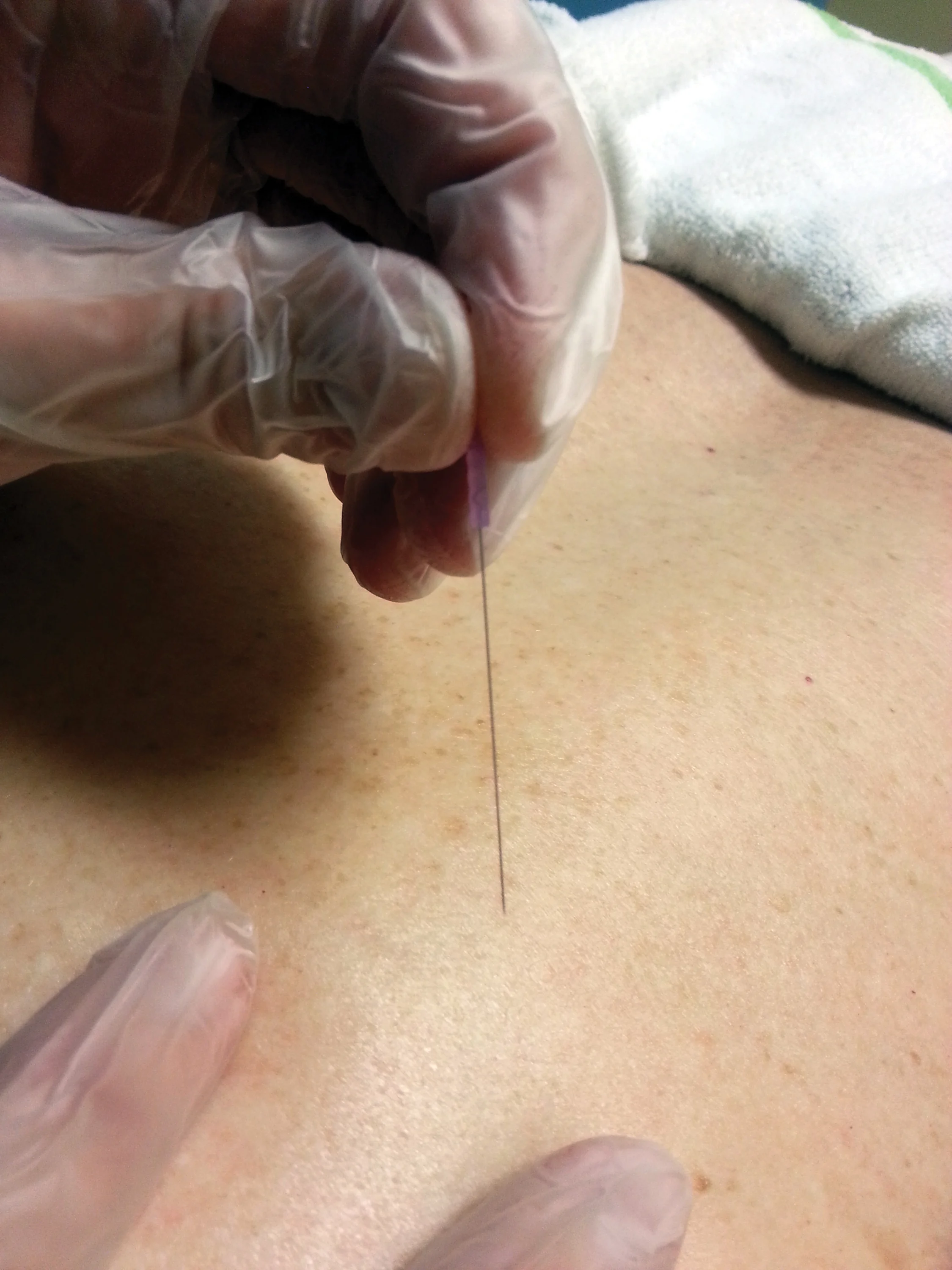 jill-dry-needling-resize-ret2.jpg