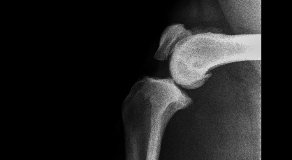 Arthritis - what is it and why does it hurt?