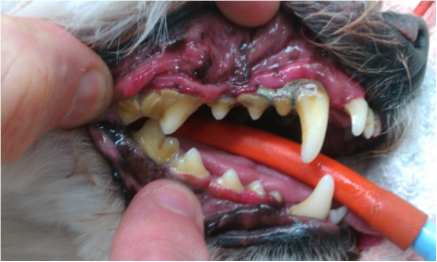 GRADE 4: Gums are swollen and red. Some teeth are wobbly, which means they have lost almost all the bone around them. Gums have receded exposing roots of the teeth. Teeth are infected. This would be painful and could lead to life threatening heart infections.