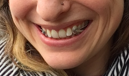 Diary of an Adult Getting Orthodontia - 10 Hours In