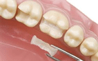 FILLINGS.gif