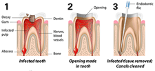 ROOT-CANALS.gif
