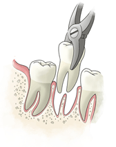 EXTRACTIONS.gif