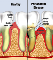 PERIODONTAL-OR-GUM-DISEASE-CARE.gif